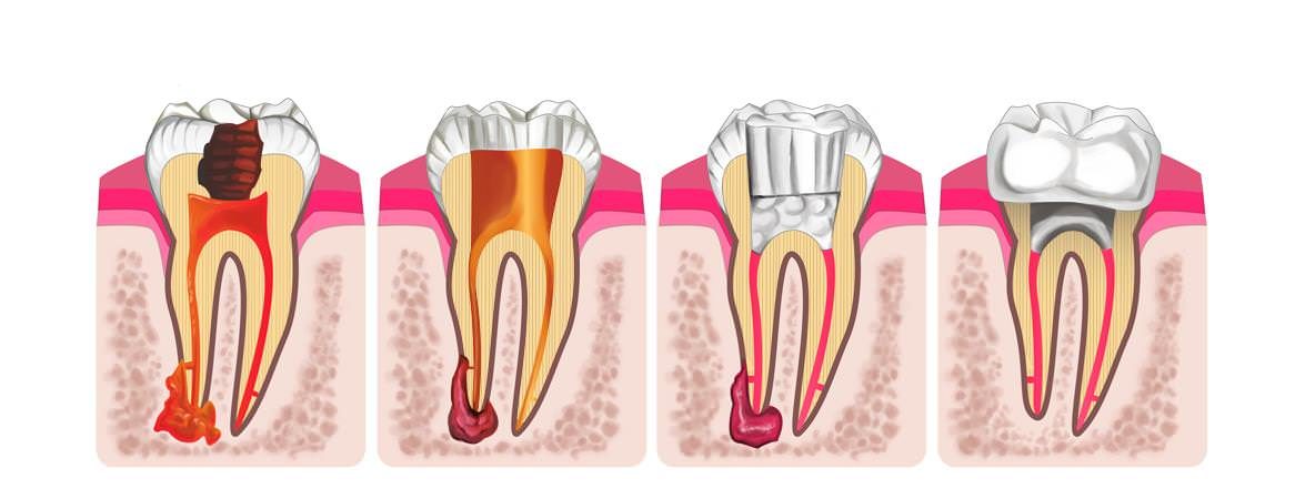 cropped-Root-Canal-cropped-for-small-header-optimized.jpg